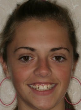 Image of patient smiling before treatment for missing lateral incisors