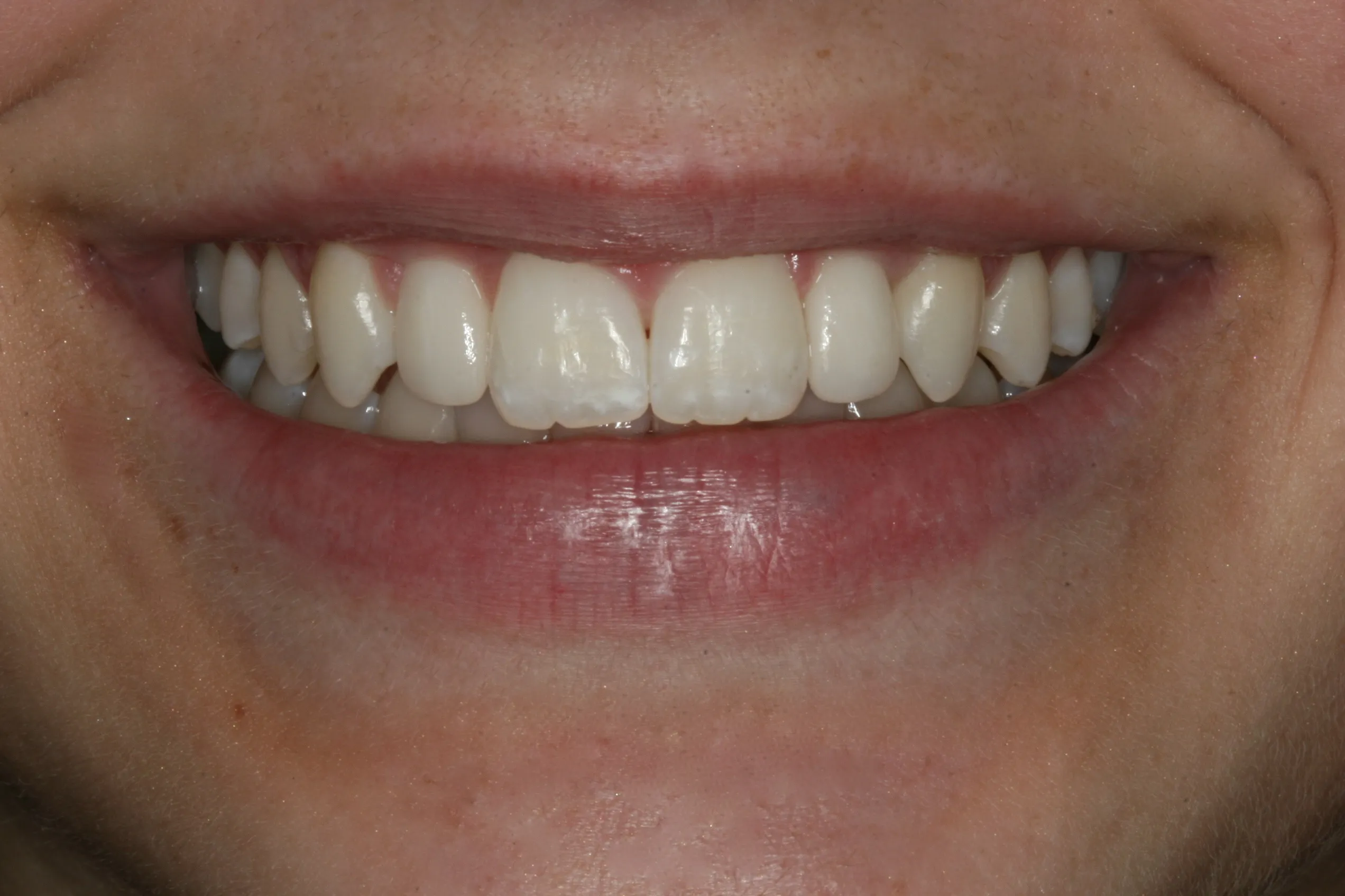 Image of patient smiling after treatment for missing lateral incisors showing corrected teeth