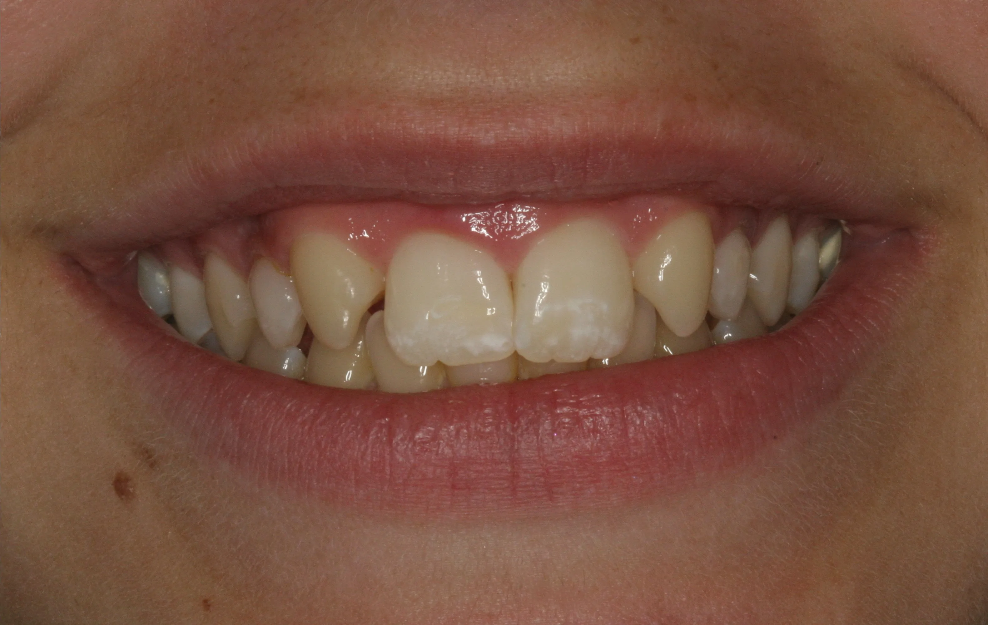 Close up image of teeth missing lateral incisors
