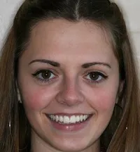 Image of patient smiling after treatment for missing lateral incisors