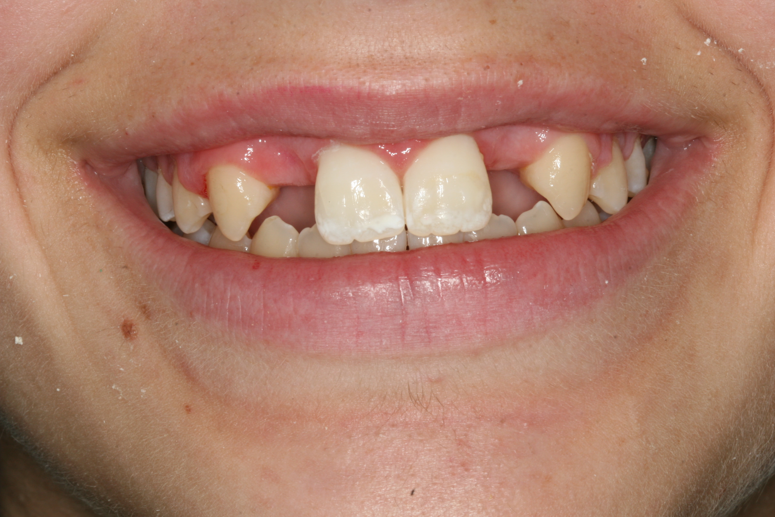 Close up image of teeth missing lateral incisors